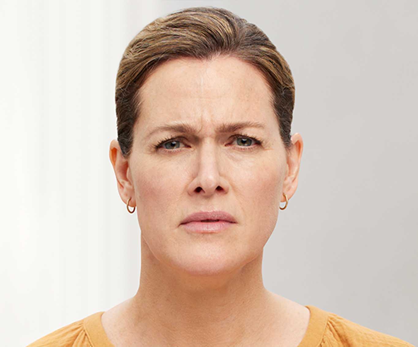 anti-wrinkle-ba-3-before