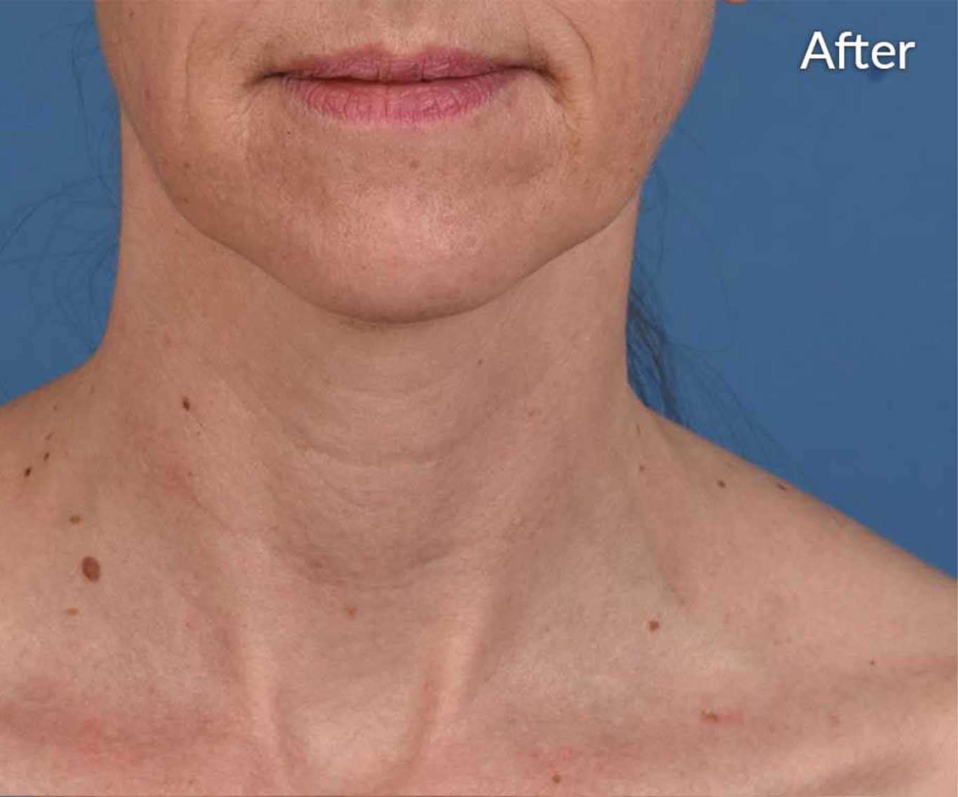 skinpen-ba-1-after