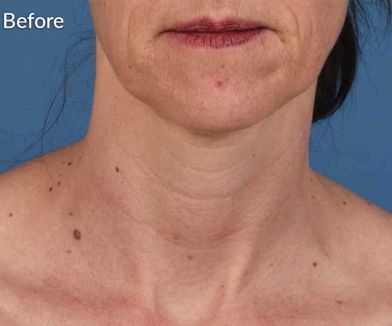 skinpen-ba-1-before