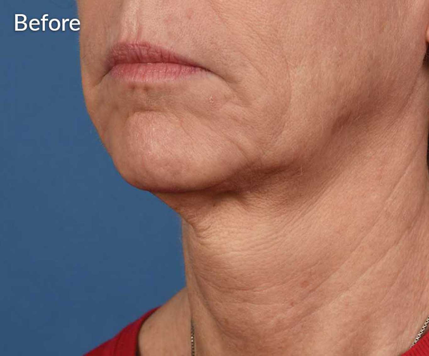 skinpen-ba-2-before