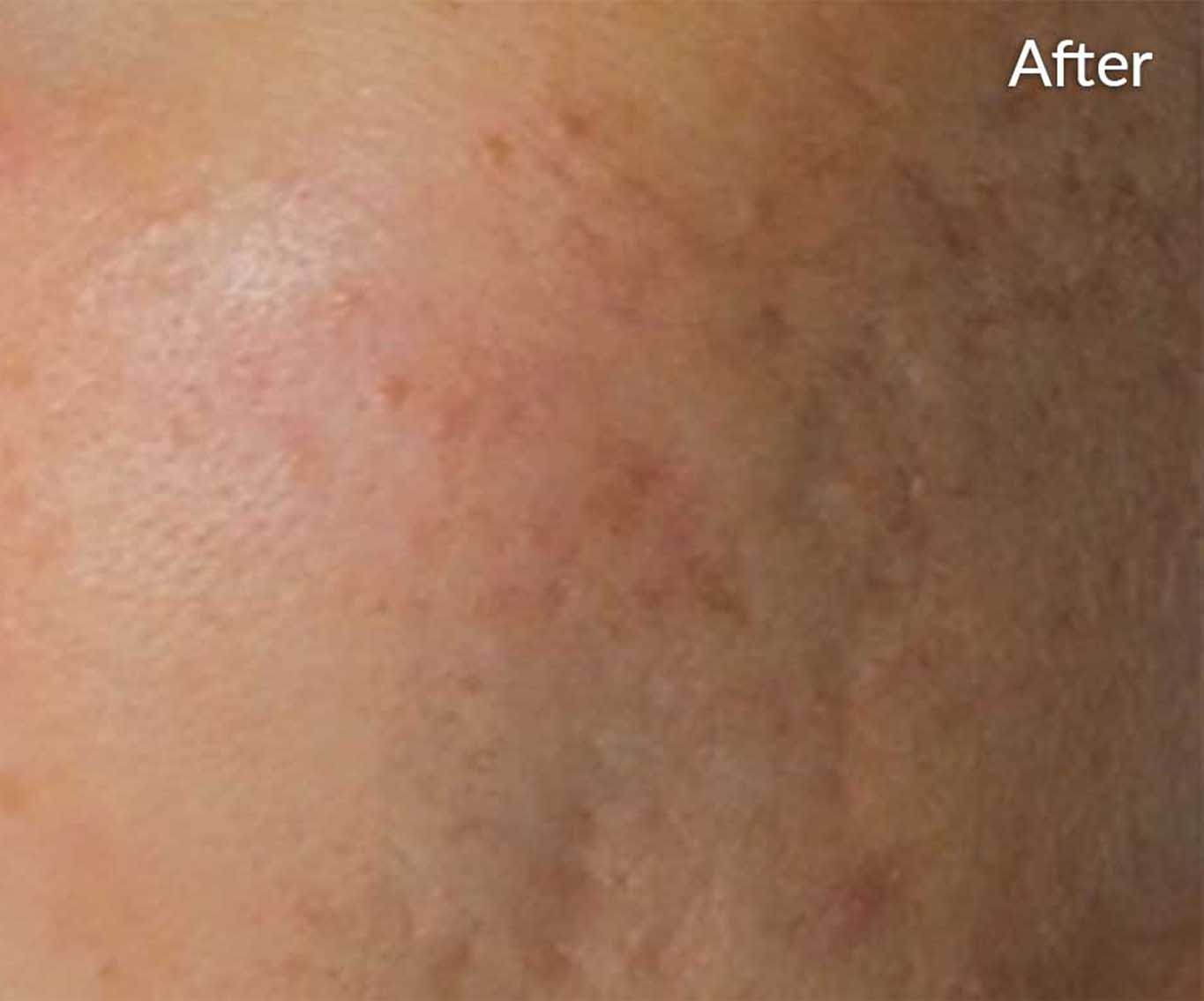 skinpen-ba-3-after