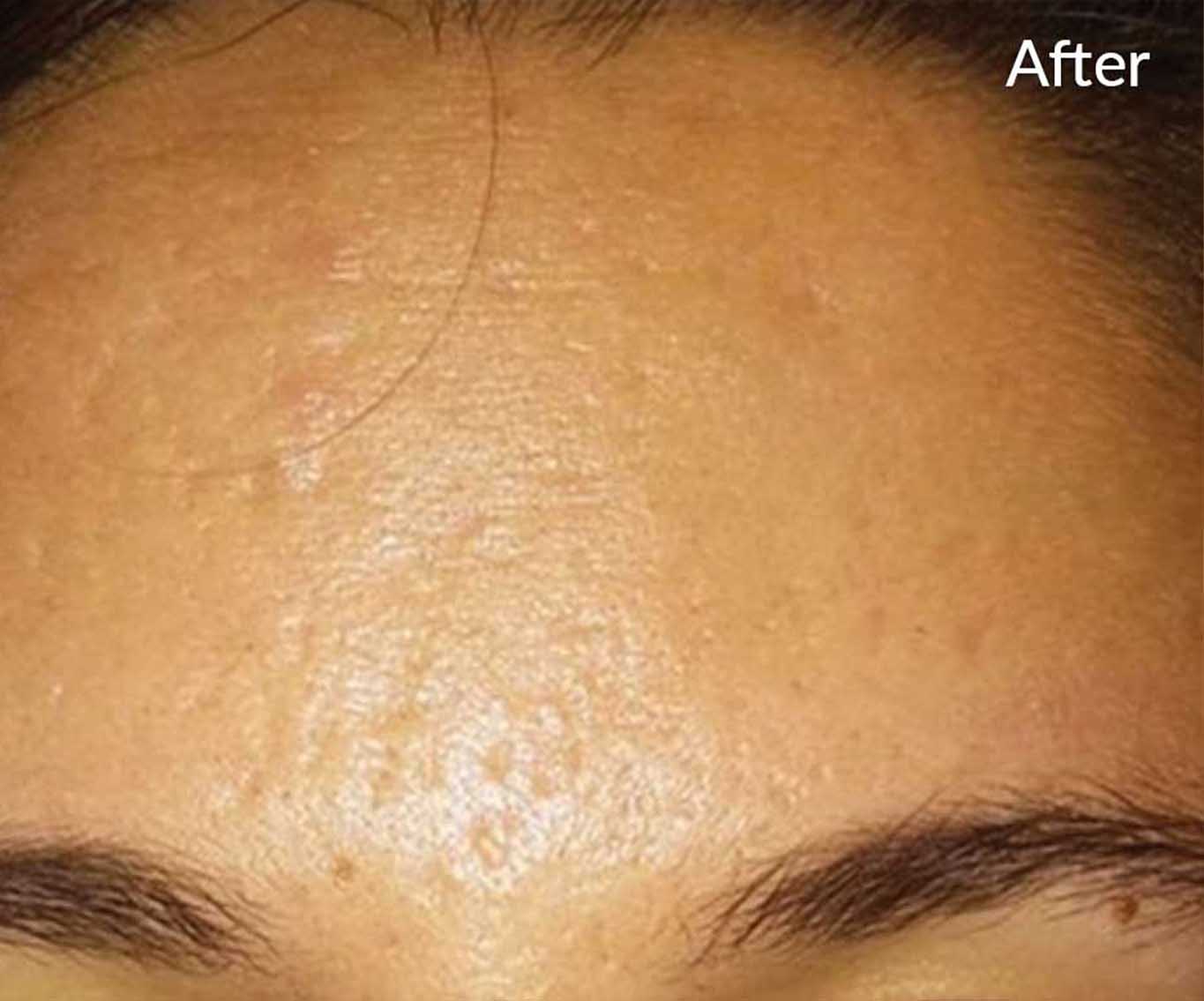 skinpen-ba-4-after