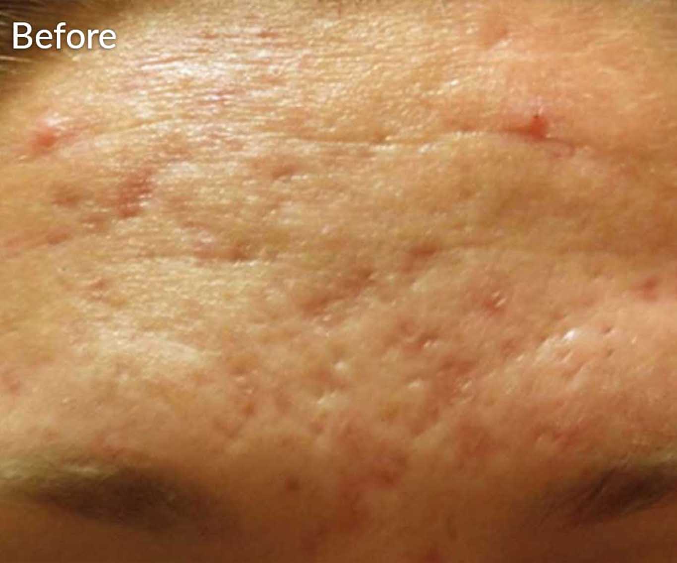 skinpen-ba-4-before